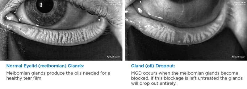 Normal vs MGD Glands